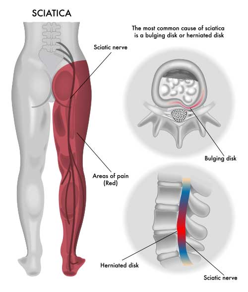 Sciatica Knee Brace: Managing Pain and Finding Relief