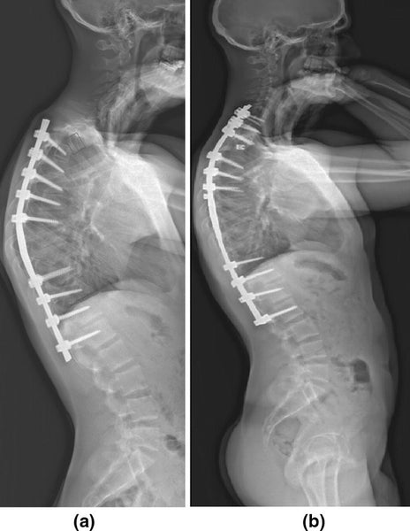 Proximal Junctional Kyphosis: Understanding, Diagnosis, and Treatment